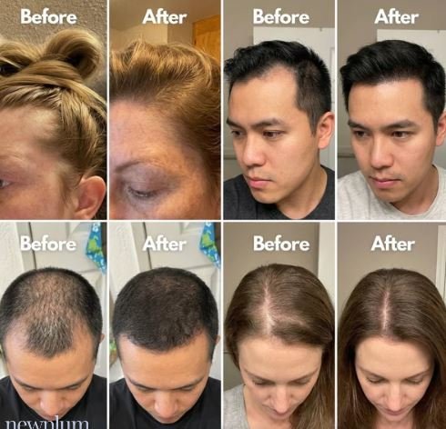 Newplum: Advanced Hair Growth Roll-On Serum
